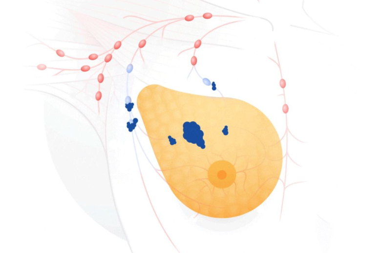 Googlen tekoäly voi havaita rintasyövän