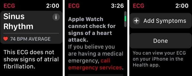 Lecture ECG Apple Watch