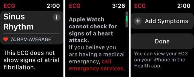 Apple Watch ECG-meting